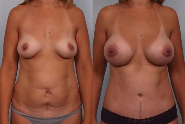 Breast Augmentation 186