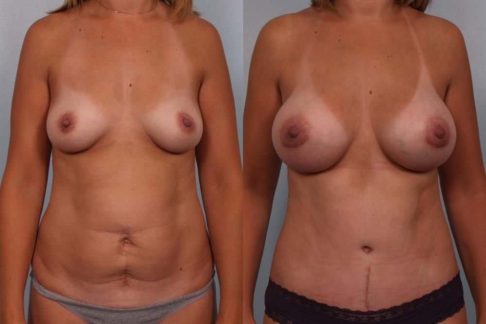 Breast Augmentation 186