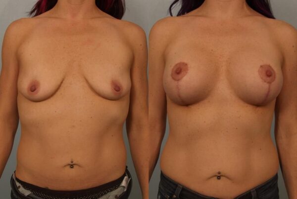 Breast Augmentation 187