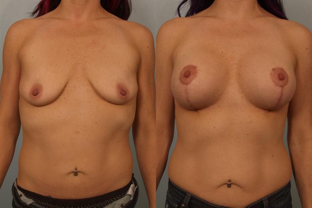 Breast Augmentation 187