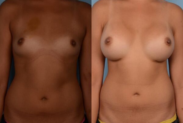 Breast Augmentation 188