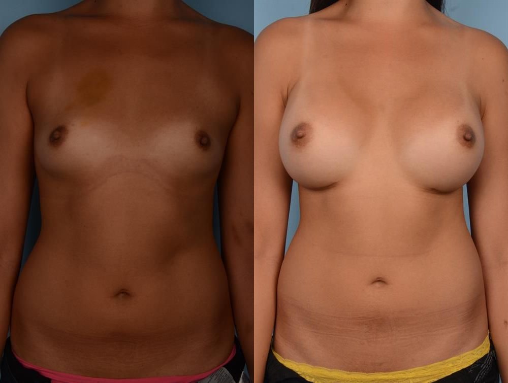 Breast Augmentation 188
