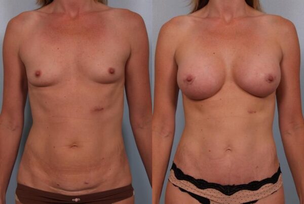 Breast Augmentation 189