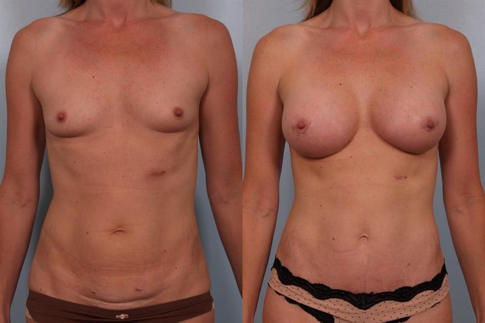 Breast Augmentation 189