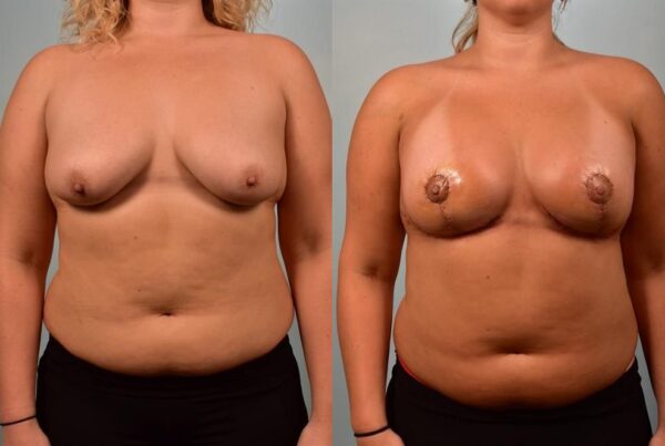 Breast Augmentation 19