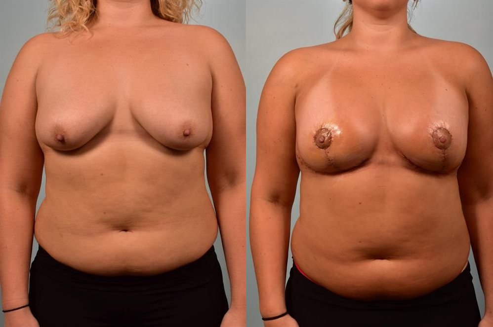 Breast Augmentation 19