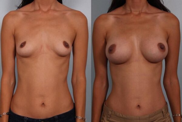 Breast Augmentation 192