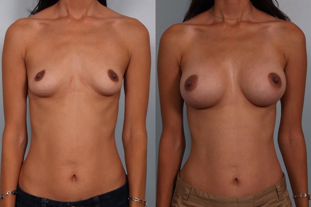 Breast Augmentation 192