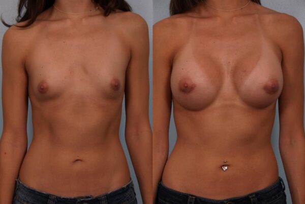 Breast Augmentation 193