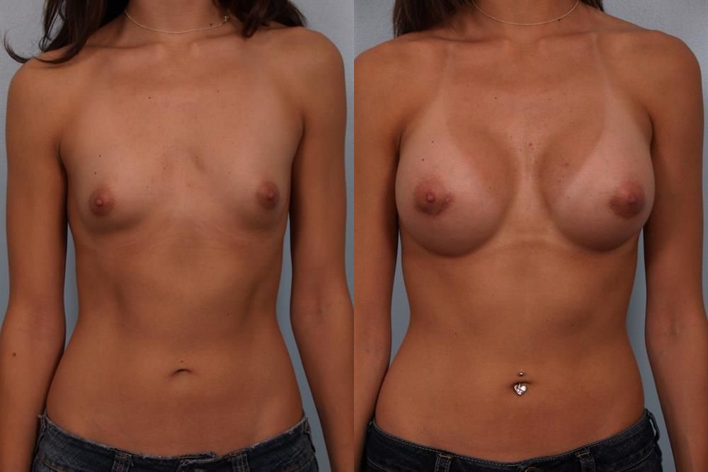 Breast Augmentation 193