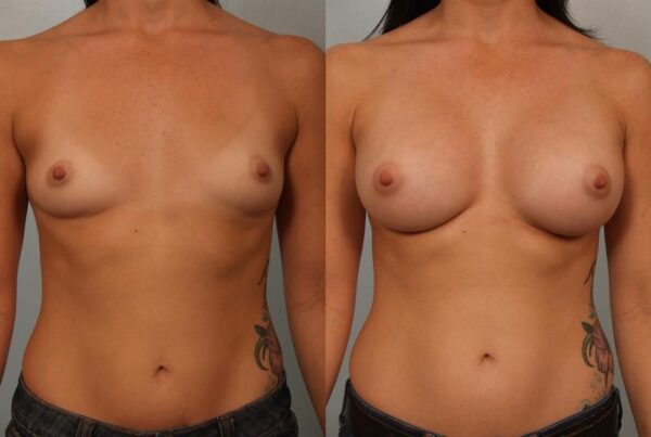 Breast Augmentation 194