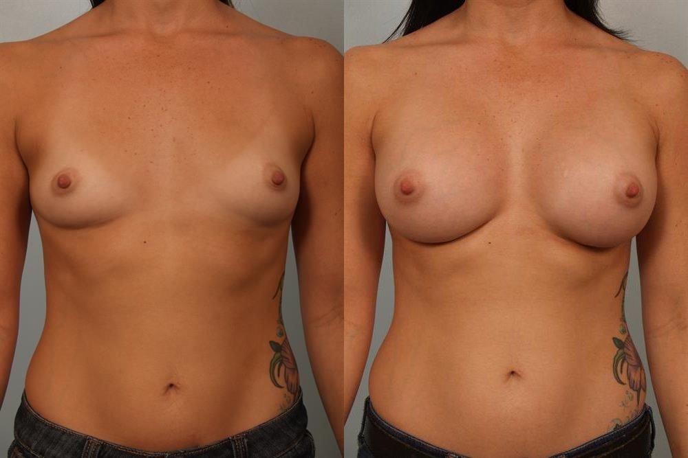 Breast Augmentation 194