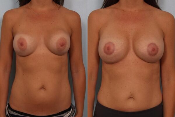 Breast Augmentation 195