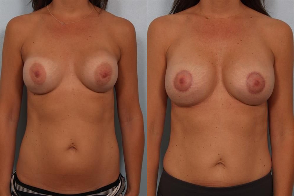 Breast Augmentation 195