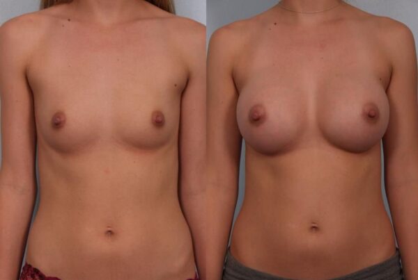Breast Augmentation 196