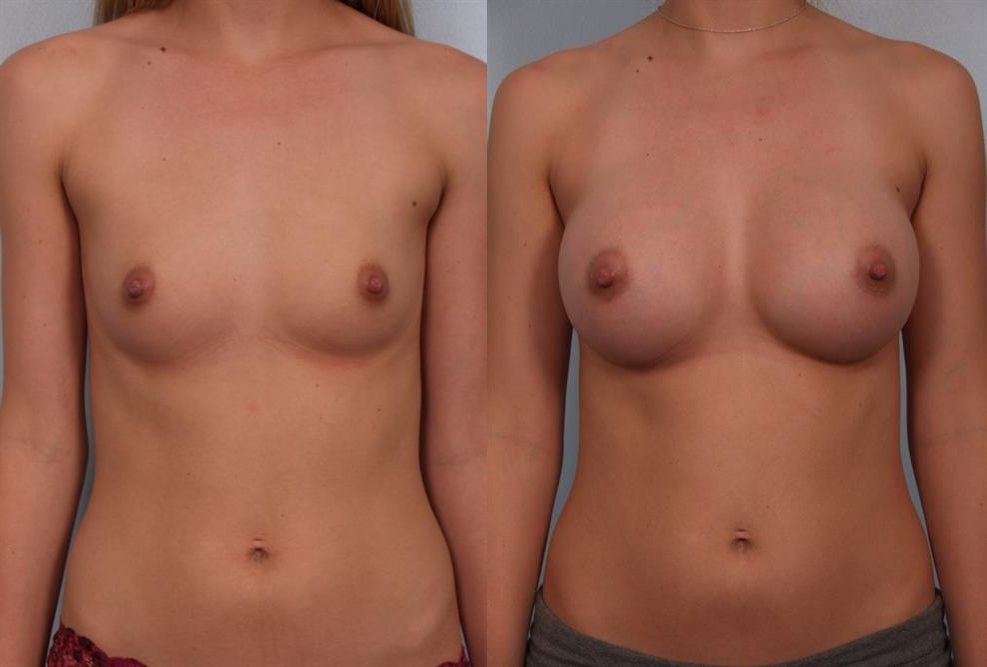 Breast Augmentation 196