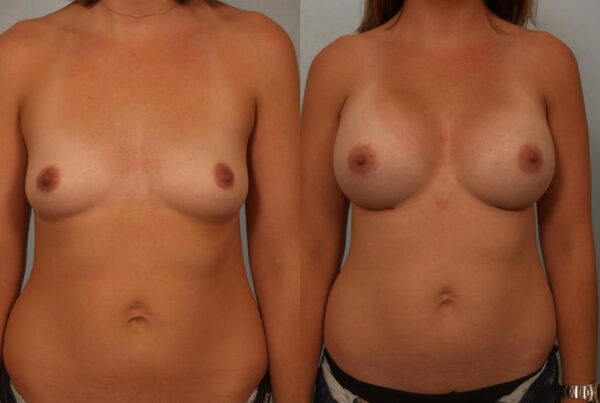 Breast Augmentation 197
