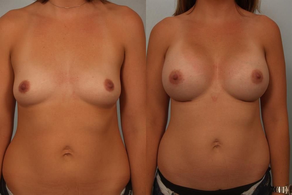 Breast Augmentation 197