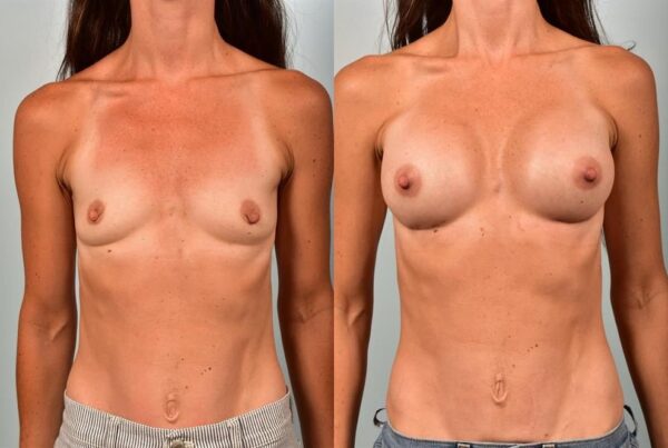 Breast Augmentation 198