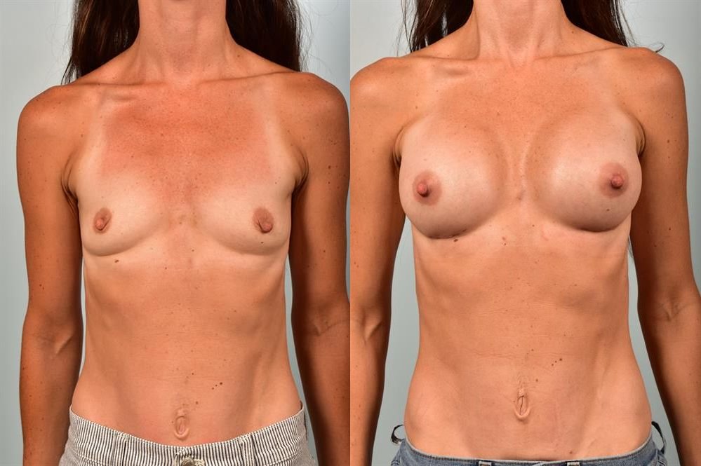 Breast Augmentation 198