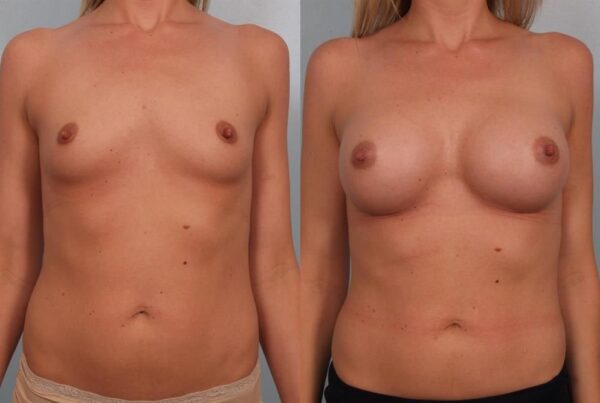 Breast Augmentation 199