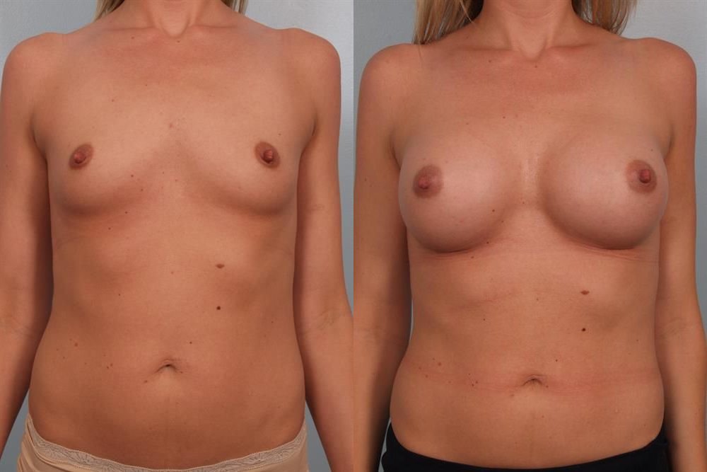 Breast Augmentation 199