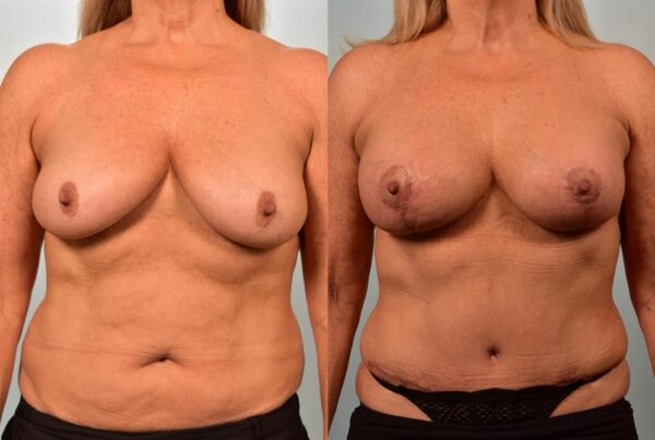 Breast Augmentation 2