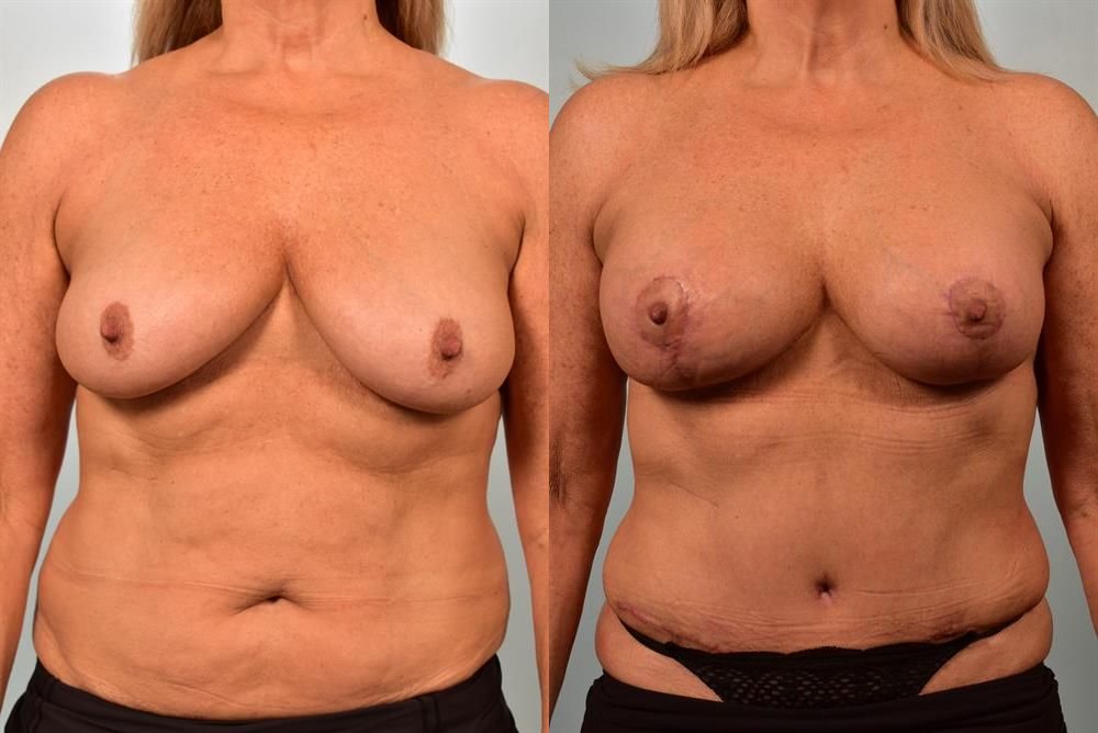 Breast Augmentation 2