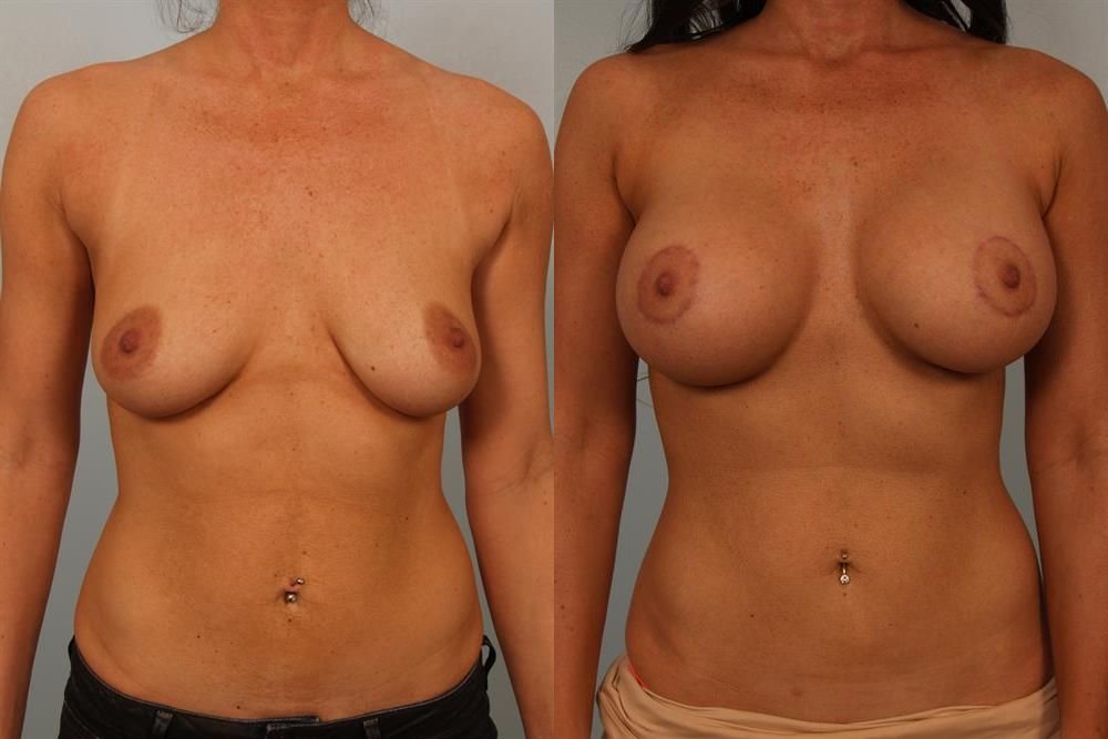 Breast Augmentation 20