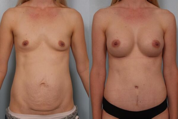Breast Augmentation 200