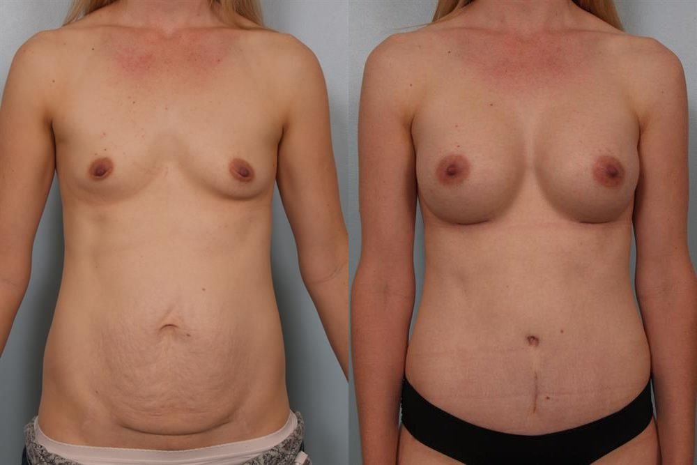Breast Augmentation 200