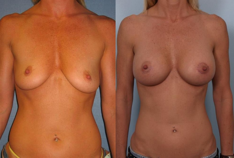 Breast Augmentation 201
