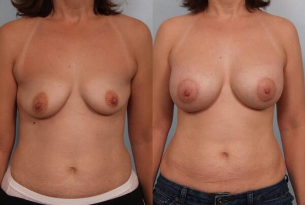 Breast Augmentation 202