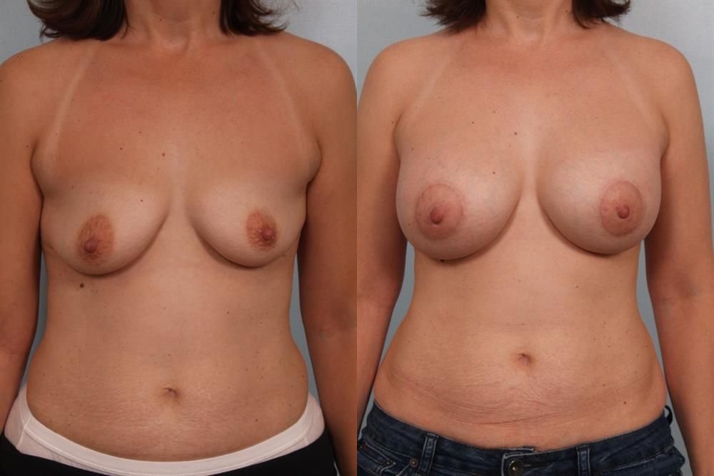 Breast Augmentation 202
