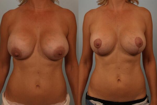 Breast Augmentation 204