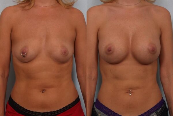Breast Augmentation 205