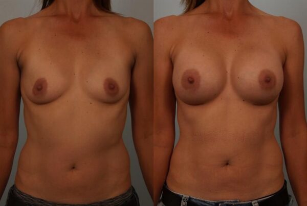 Breast Augmentation 206
