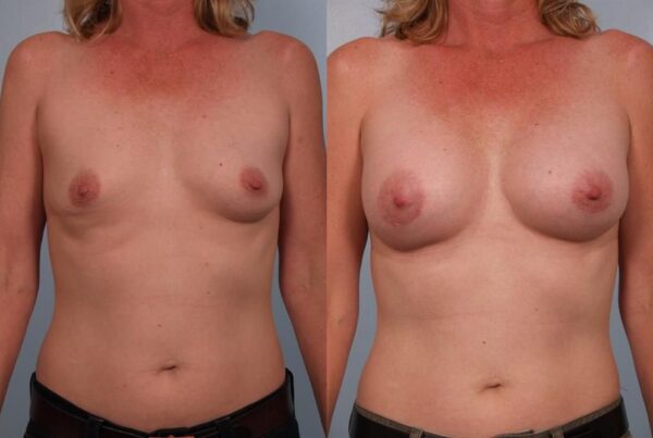 Breast Augmentation 207