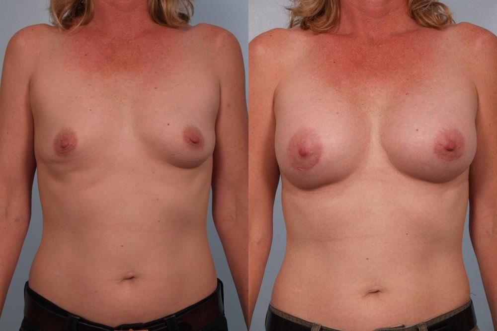 Breast Augmentation 207