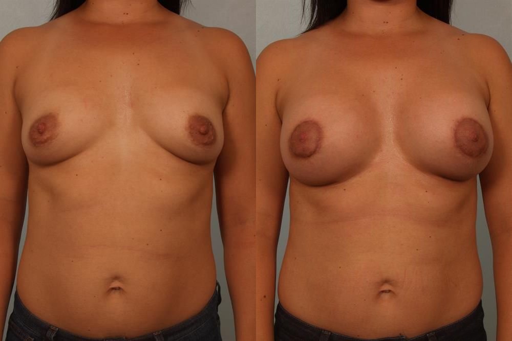 Breast Augmentation 208