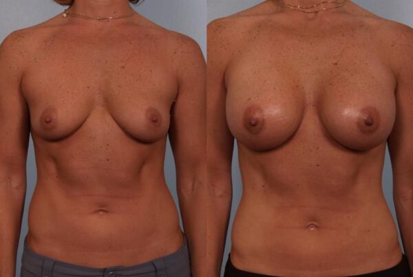 Breast Augmentation 209
