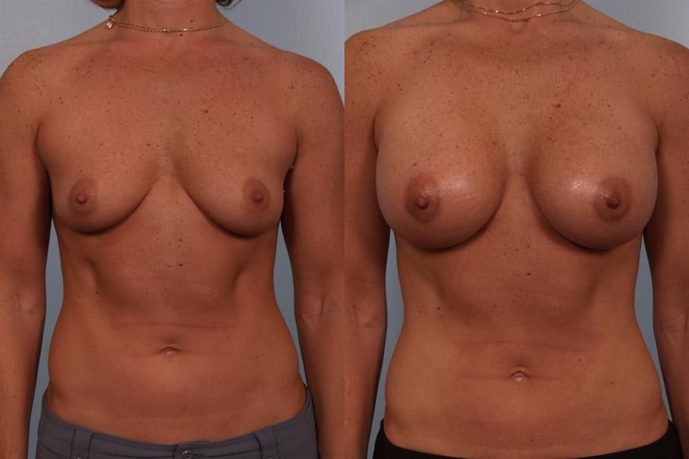 Breast Augmentation 209
