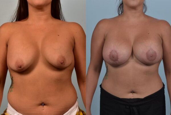 Breast Augmentation 21