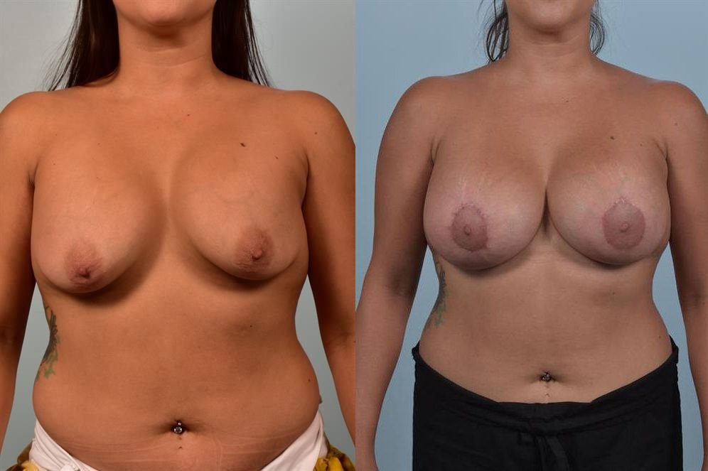 Breast Augmentation 21