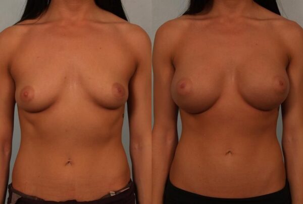 Breast Augmentation 210