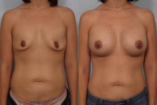 Breast Augmentation 212