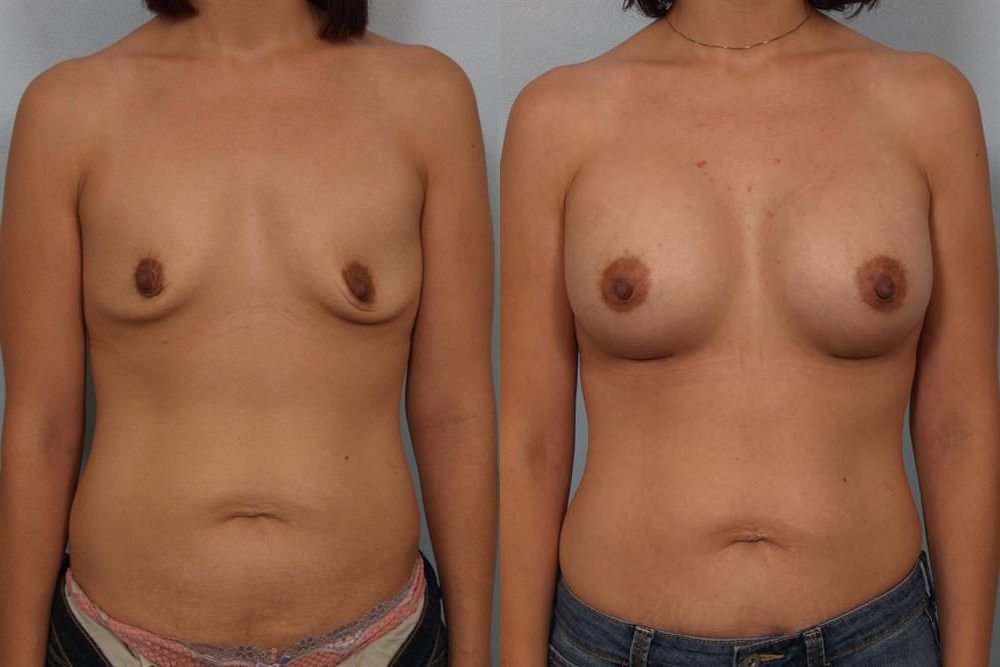 Breast Augmentation 212