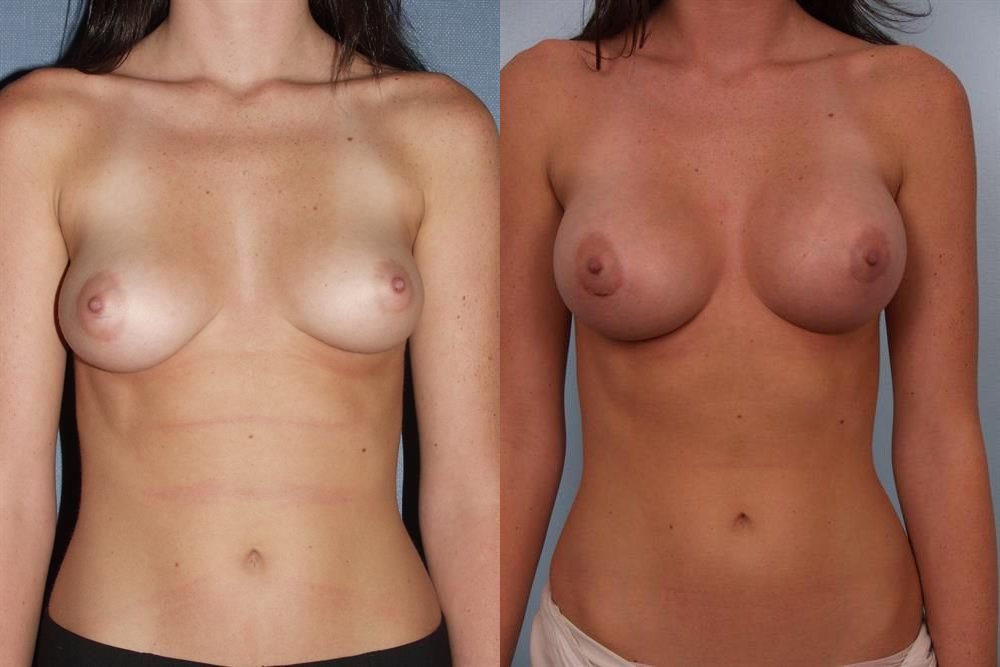 Breast Augmentation 213