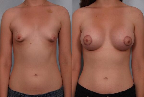 Breast Augmentation 214