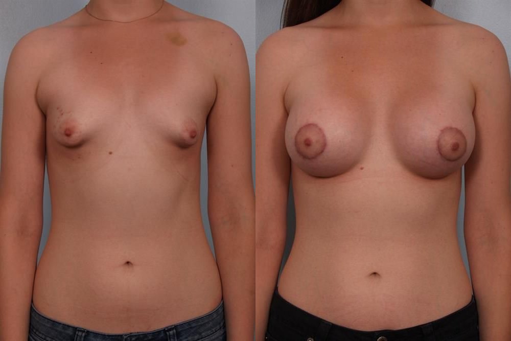 Breast Augmentation 214